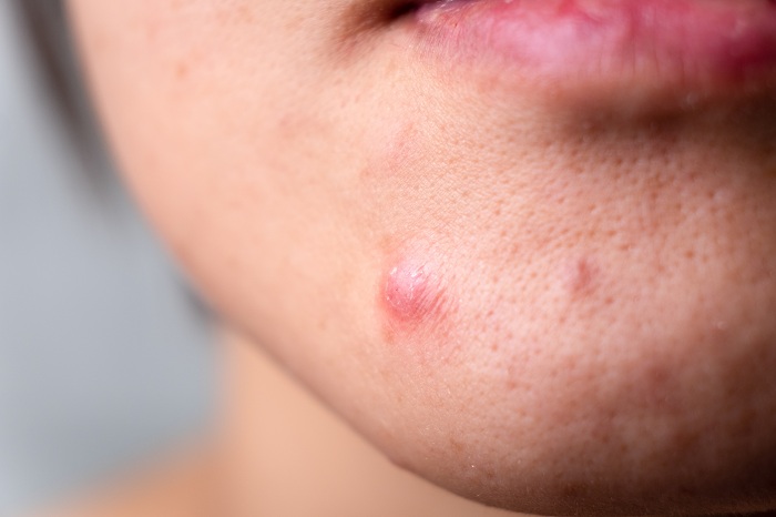 Jawline Acne: Treatment & Prevention Tips That Actually Work