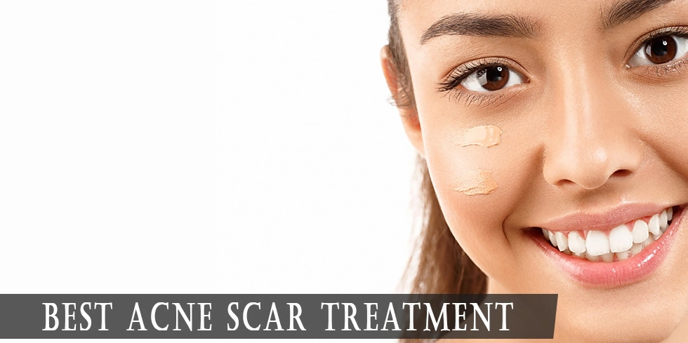 best acne scar treatment options