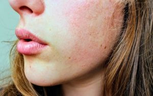 Damaging facial skin of a woman